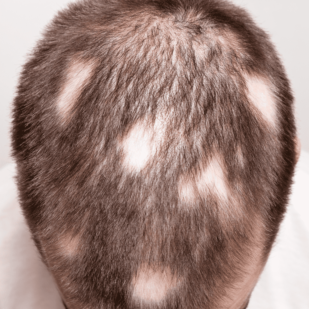alopecia smp