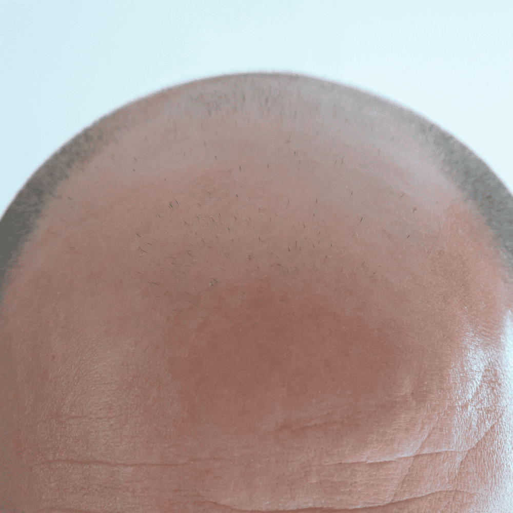 Male Pattern Baldness